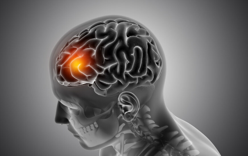 Identifican una red cerebral clave detrás de los síntomas del Parkinson